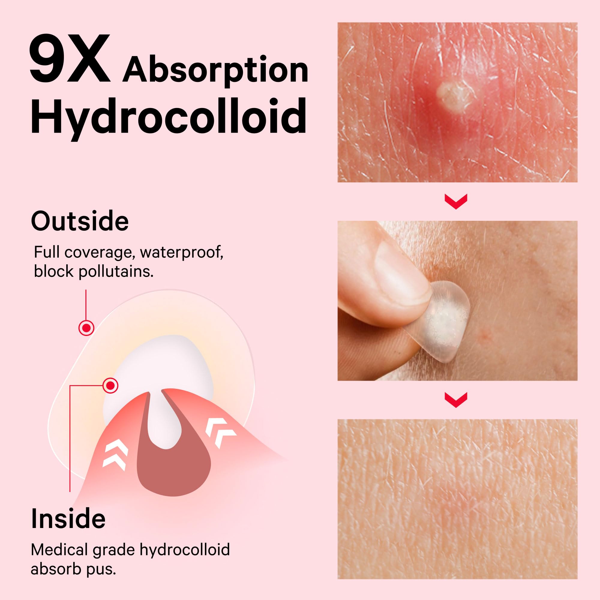 Sosky Pimple Patches all-day adhesion staying put during workouts and sleep