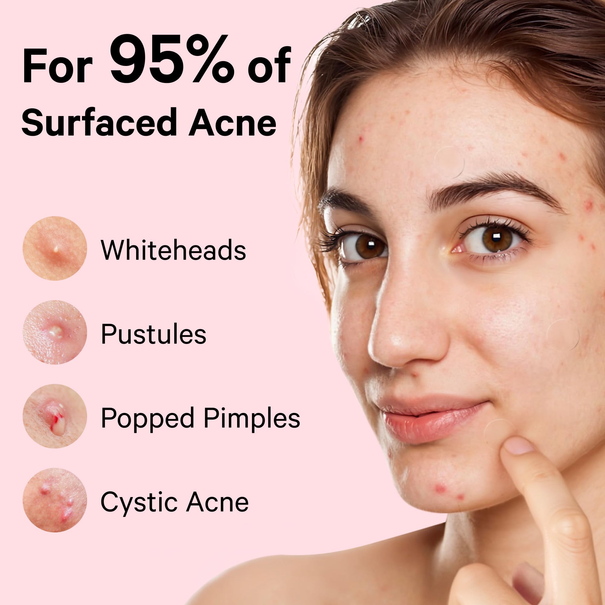 Sosky Pimple Patches closeup showing thin discreet patch on skin