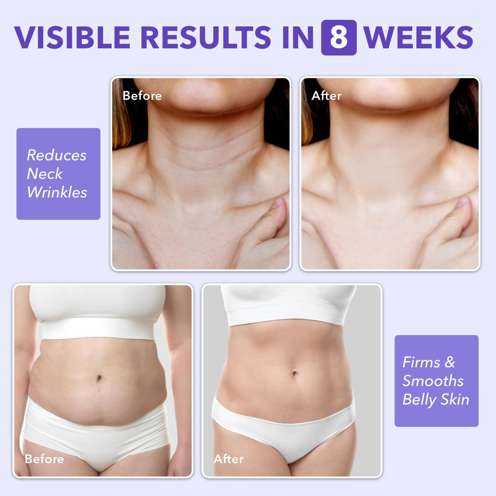 Sperandi Overnight Toning Whip on belly illustrating lifting and contouring potential.