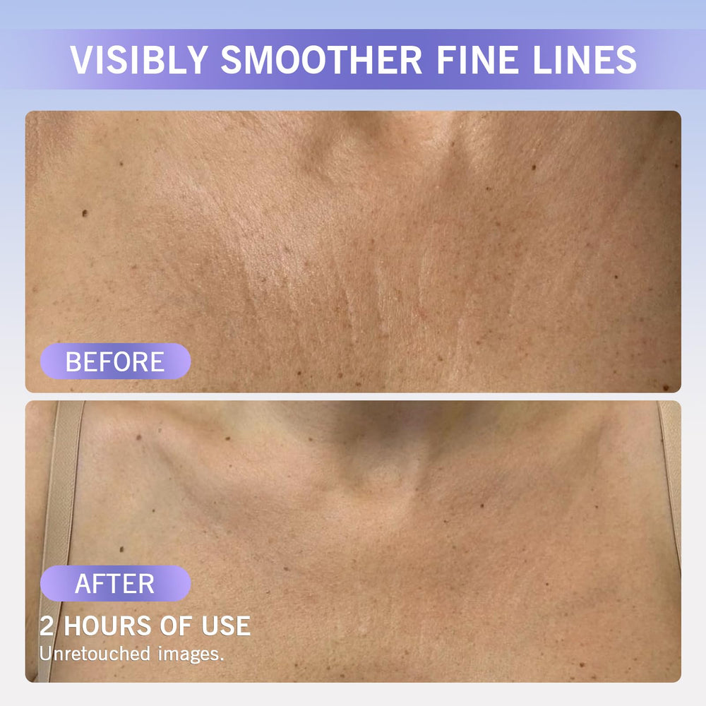 Stasover soft-flexible patches shown comfortable to wear overnight on clean skin.