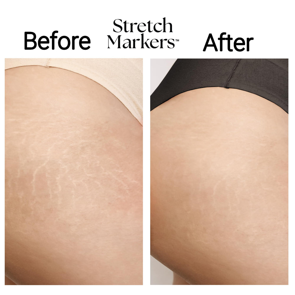 StretchMarkers Therapy bioactive peptides support skin resilience and visible texture improvement.