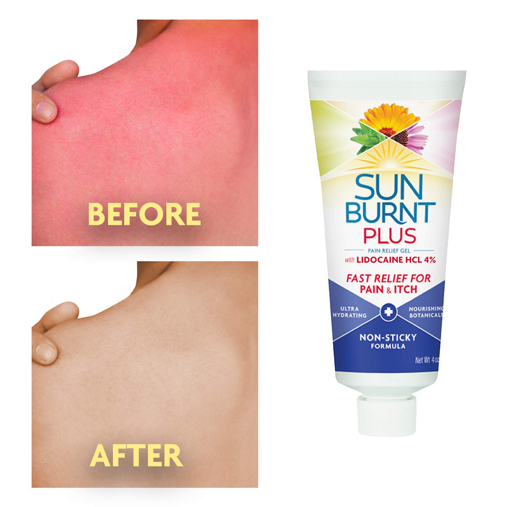 Sunburnt Plus calendula flowers illustrate soothing anti-inflammatory botanicals in the formula.