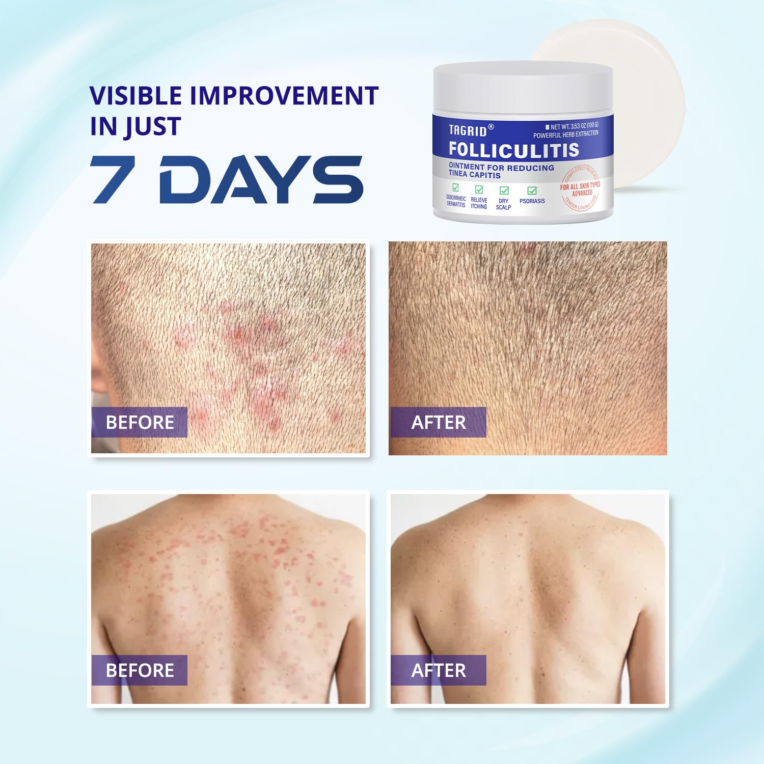 TAGRID Folliculitis Cream packaging emphasizes natural organic ingredients.