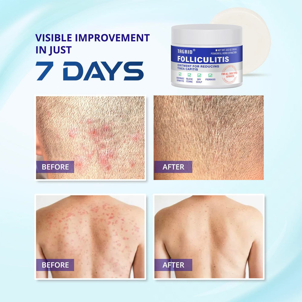TAGRID Folliculitis Cream packaging emphasizes natural organic ingredients.