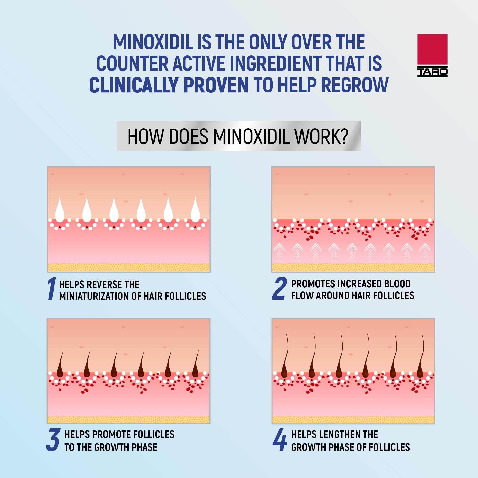 TARO Minoxidil foam applied to scalp demonstrates convenient home use.