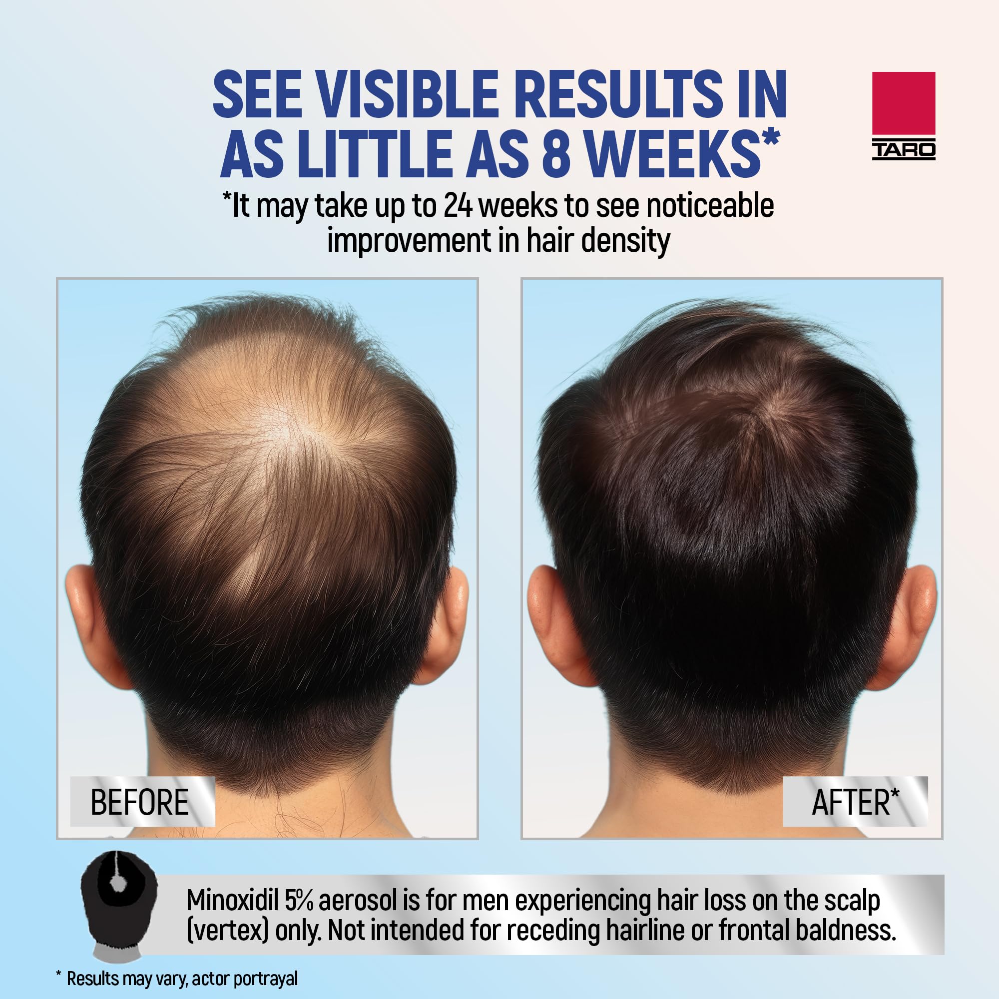TARO Minoxidil foam label shows active ingredient details for informed use.