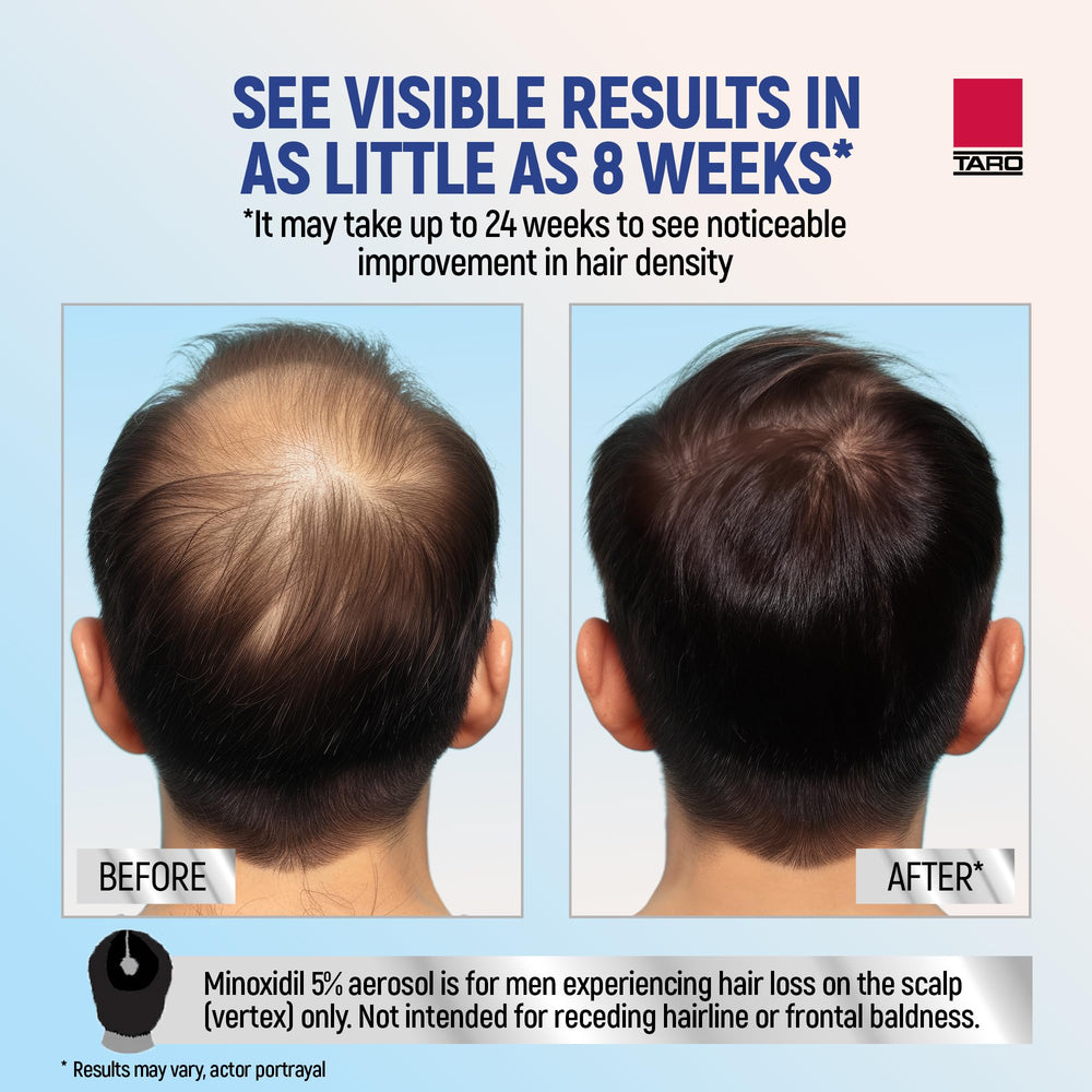 TARO Minoxidil foam label shows active ingredient details for informed use.