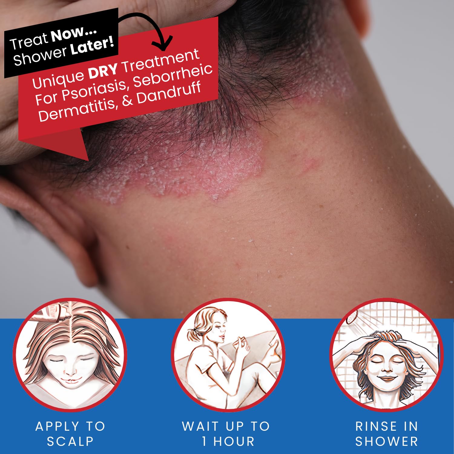 Tarsum Extra Strength Psoriasis Shampoo on scalp in use demonstrates 10% LCD coal tar formulation.