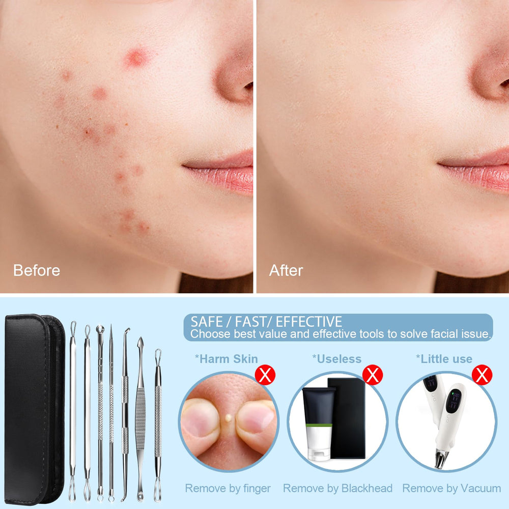 Teenitor all-skin-types safe acne tools designed for gentle, controlled extraction