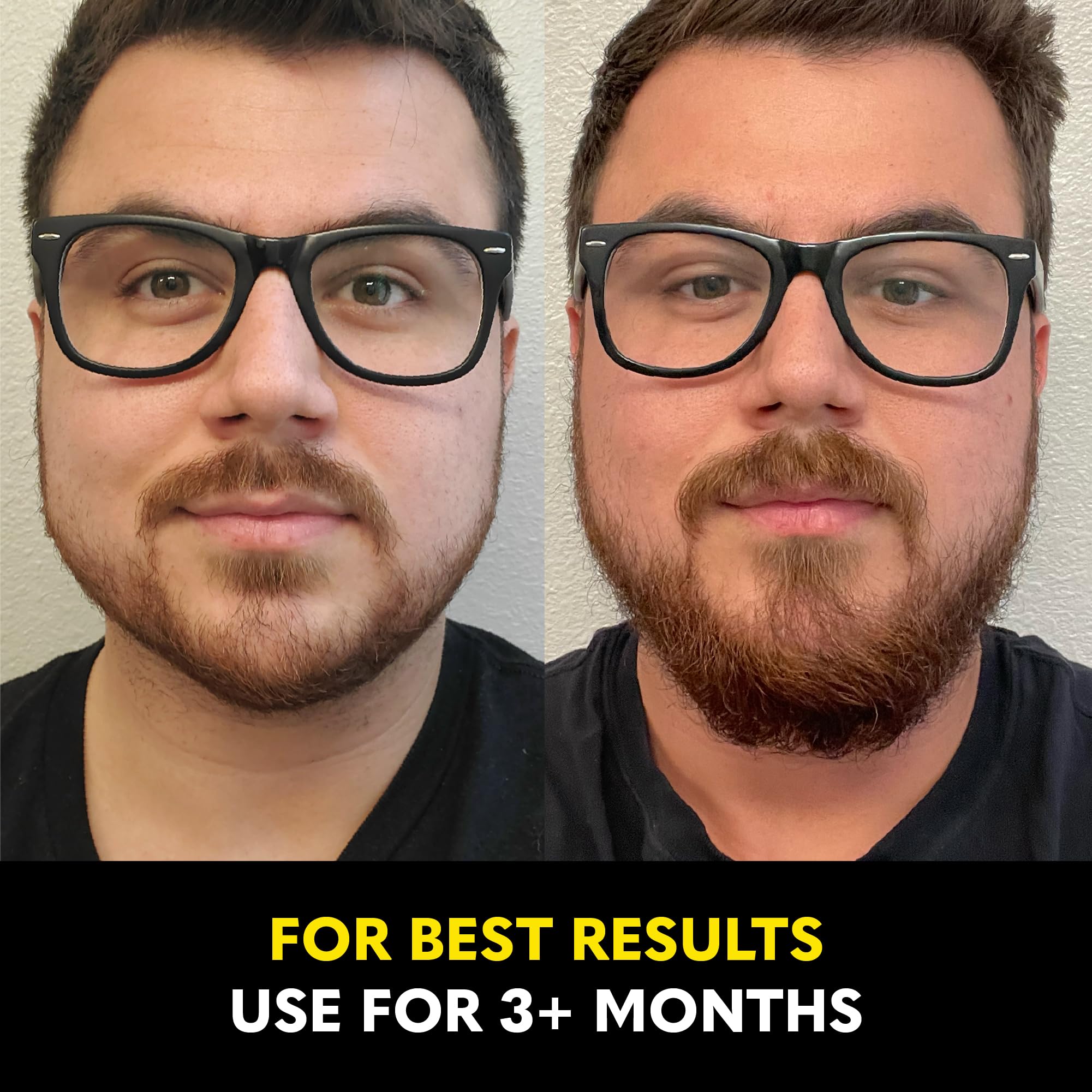 The Beard Club Biotin Vitamin Spray applied to beard areas for targeted nourishment.
