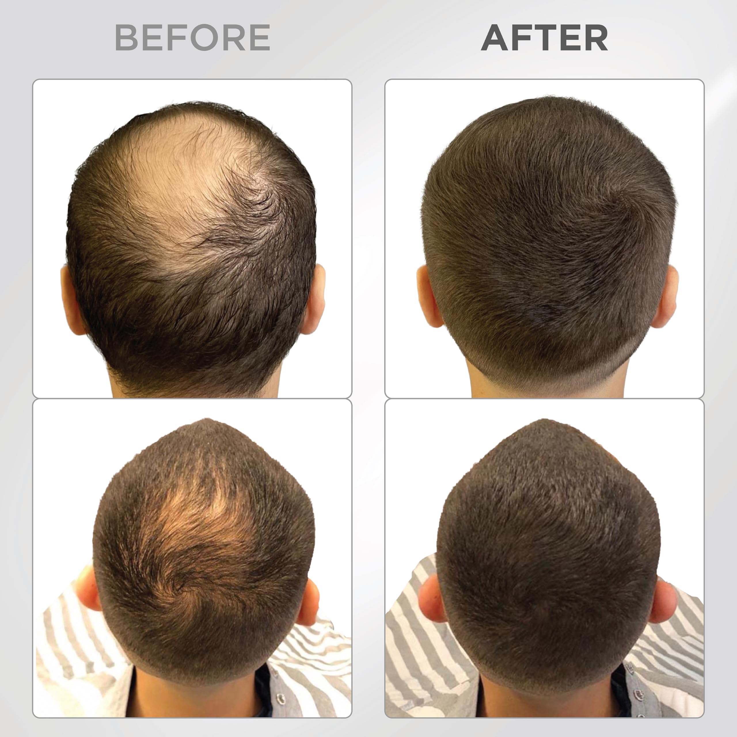 THICK FIBER being applied to dry thinning hair for quick coverage.