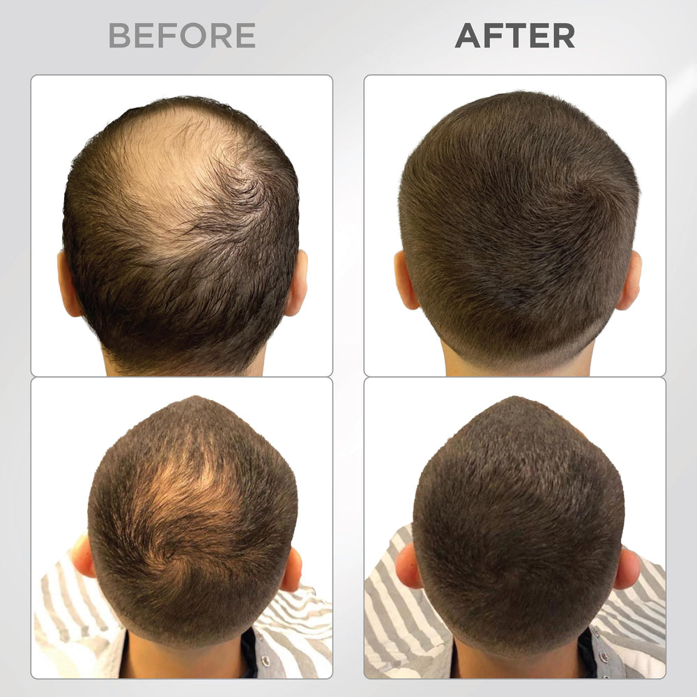 THICK FIBER being applied to dry thinning hair for quick coverage.