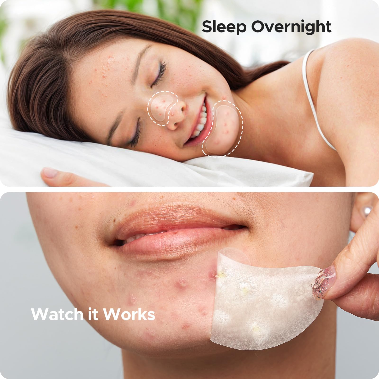 TKTK chin-patch-hydrocolloid-closeup-technology highlights skin-friendly absorption