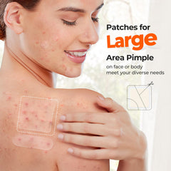 TKTK 8mm spot patch for precise blemish coverage.