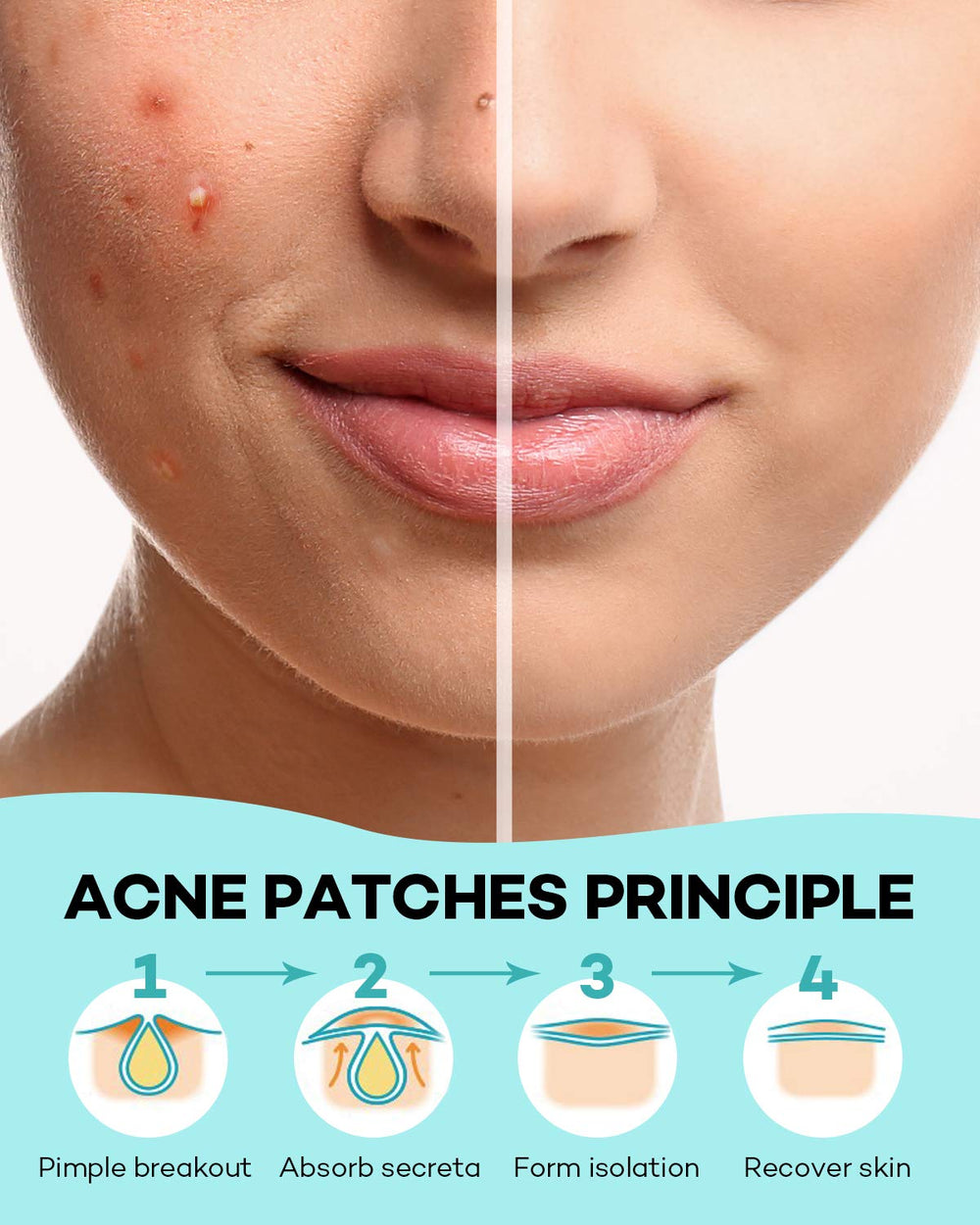 TKTK Pimple Patch hydrocolloid closeup emphasizes breathable, skin-friendly texture.