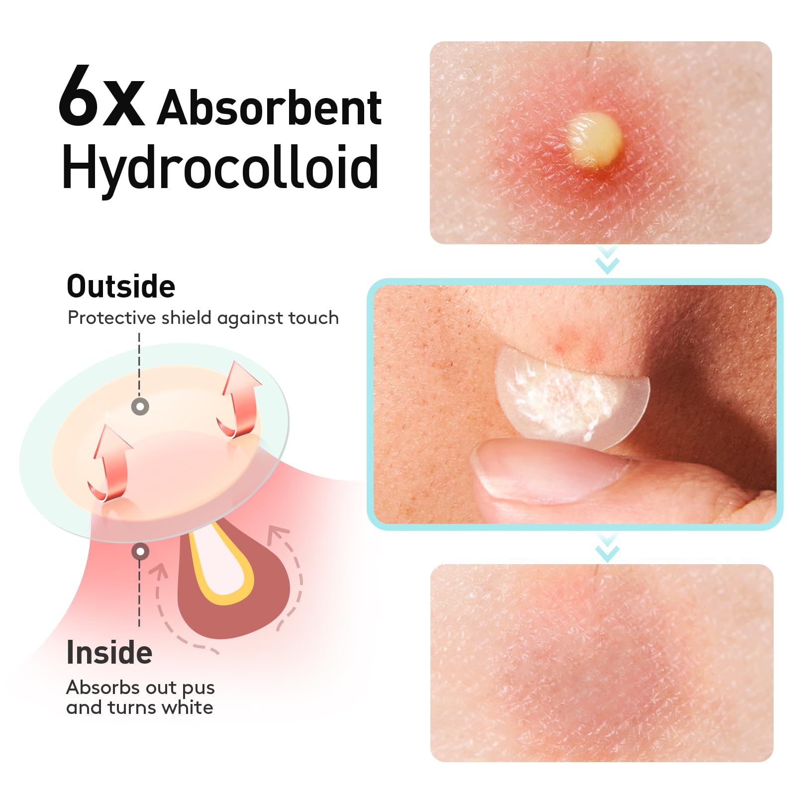 TKTK Pimple Patch hydrocolloid close-up illustrating strong absorption.