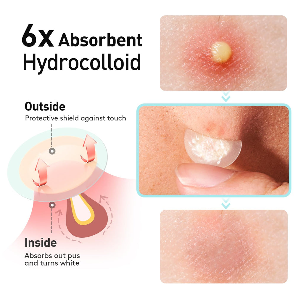 TKTK Pimple Patch hydrocolloid close-up illustrating strong absorption.