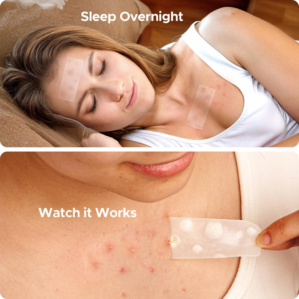 TKTK hydrocolloid patches show fast, strong absorption for blemishes.