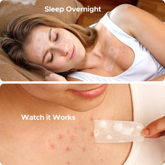 TKTK hydrocolloid patches show fast, strong absorption for blemishes.