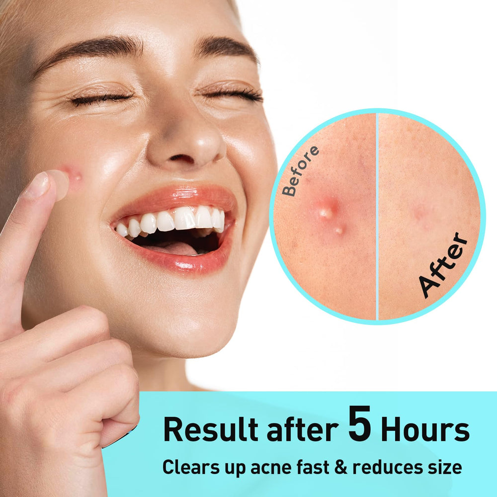 TKTK Pimple Patches matte finish wear under makeup.