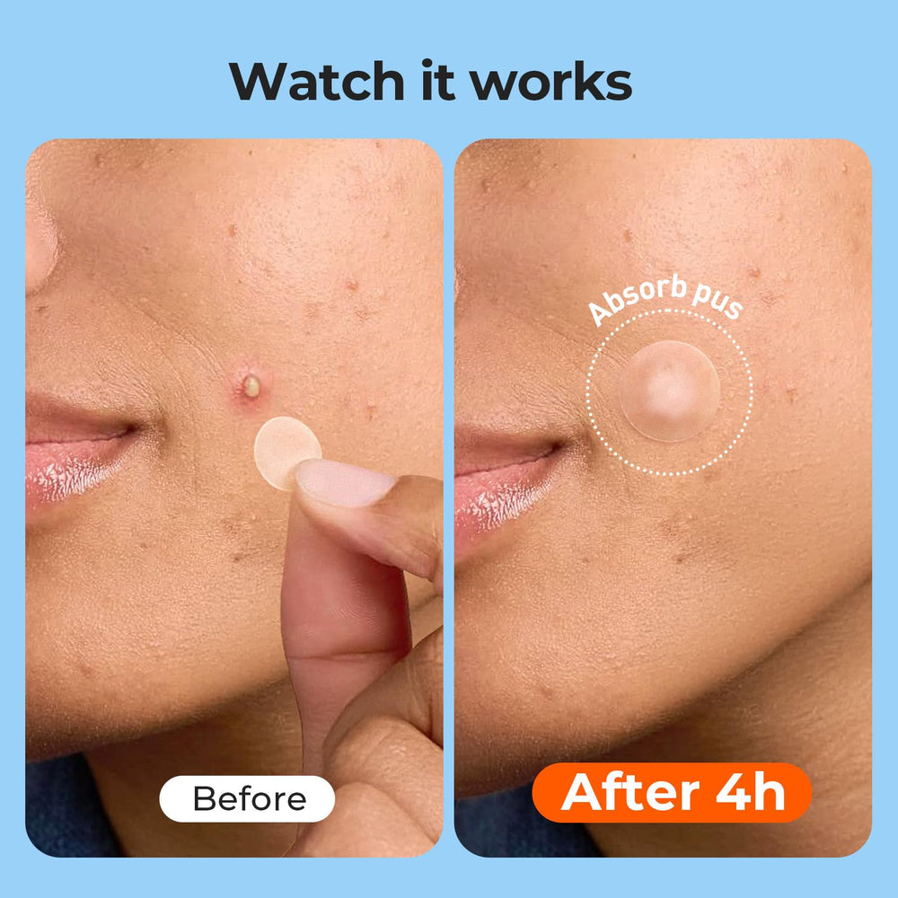 TKTK Pimple Patches nose strips for pore cleansing and oil absorption.