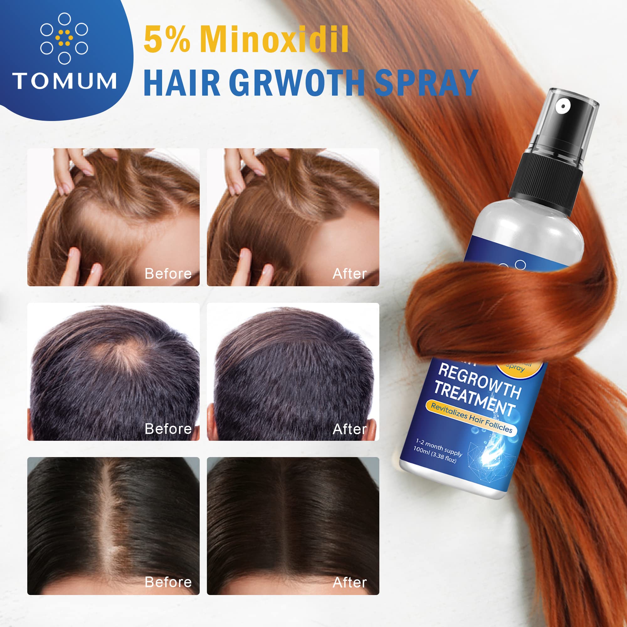 TOMUM Minoxidil spray beard application supports facial hair coverage