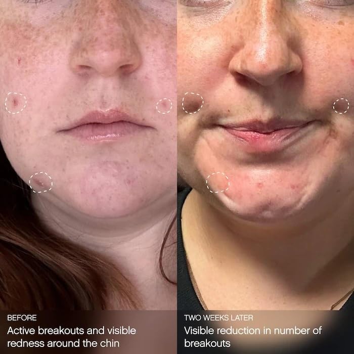 Topicals Clearly Breakout Mask redness relief close-up on inflamed skin.