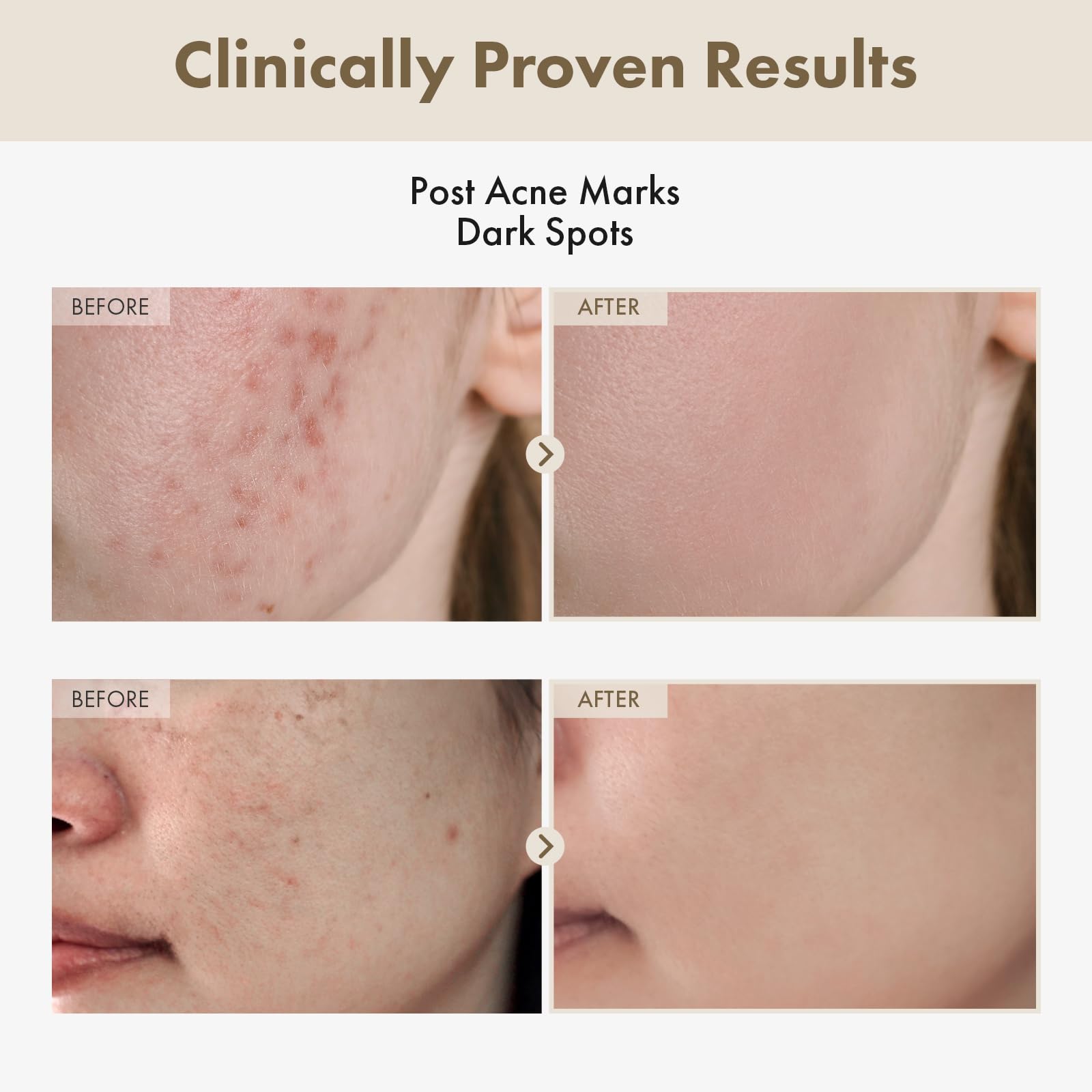 TOSOWOONG Alpha Arbutin 2 Rice Serum dropper enables precise application for even tone.