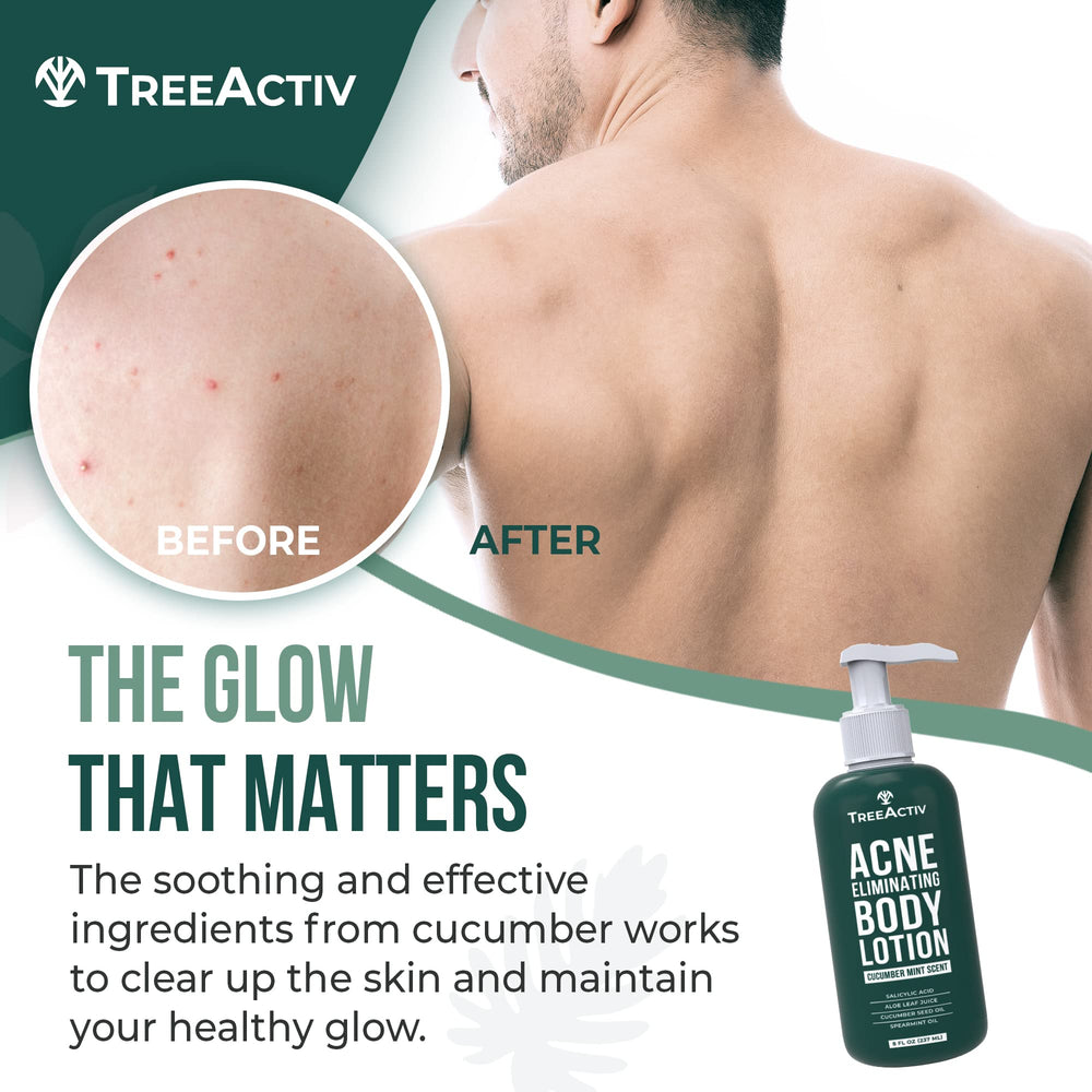 TreeActiv Acne Eliminating Body Lotion label closeup highlighting tea tree and cucumber