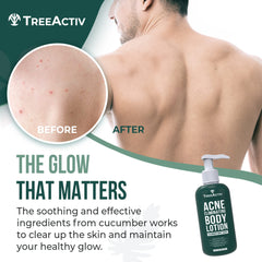 TreeActiv Acne Eliminating Body Lotion label closeup highlighting tea tree and cucumber