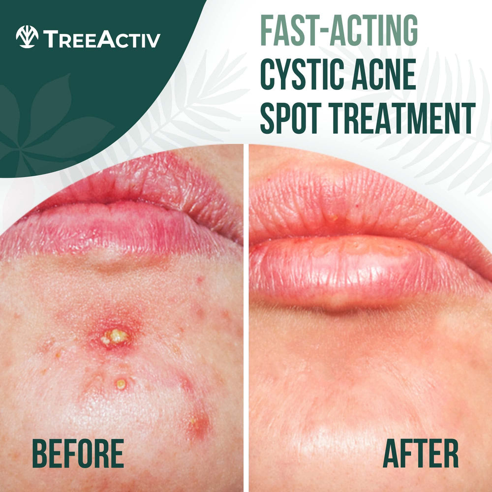 TreeActiv cystic acne spot-treatment dab application shows targeted use for individual blemishes.