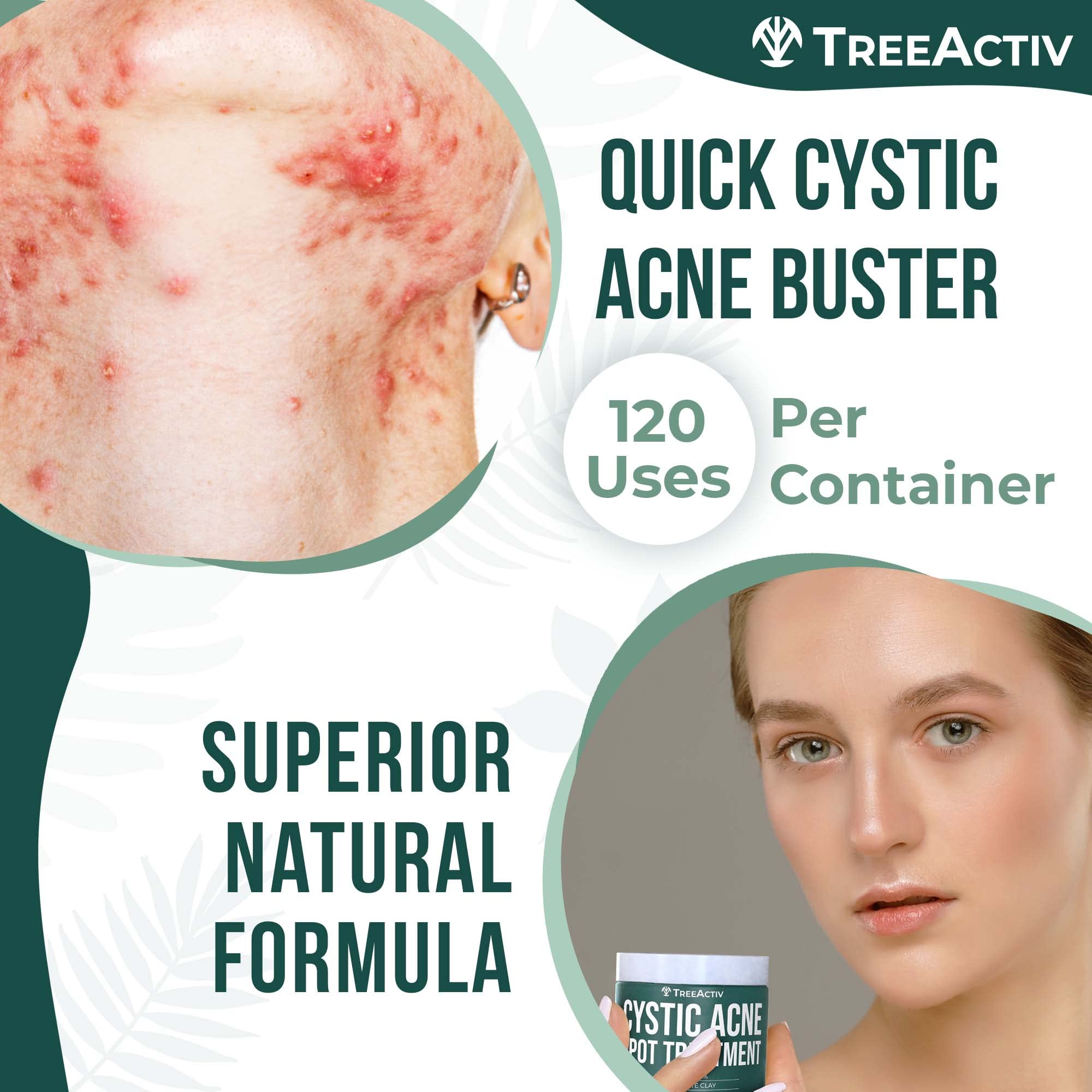 TreeActiv cystic acne spot-treatment tea-tree-oil detail suggests soothing cleansing benefits.