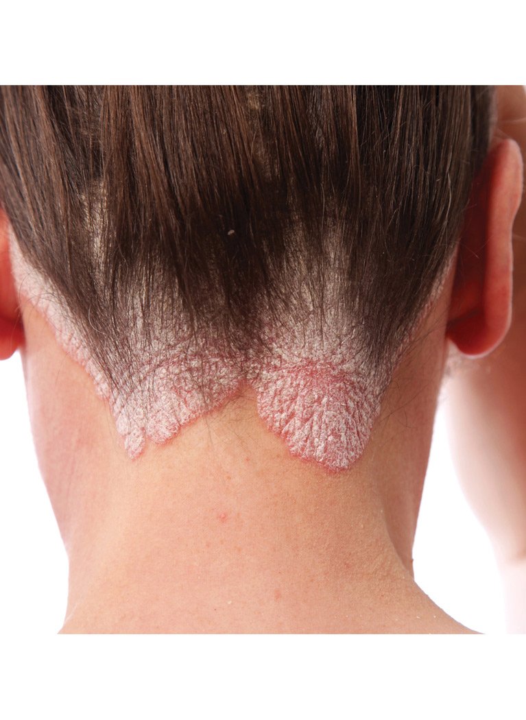 TriDerma Psoriasis Control shampoo lather scene illustrating gentle cleansing for dry scalp.