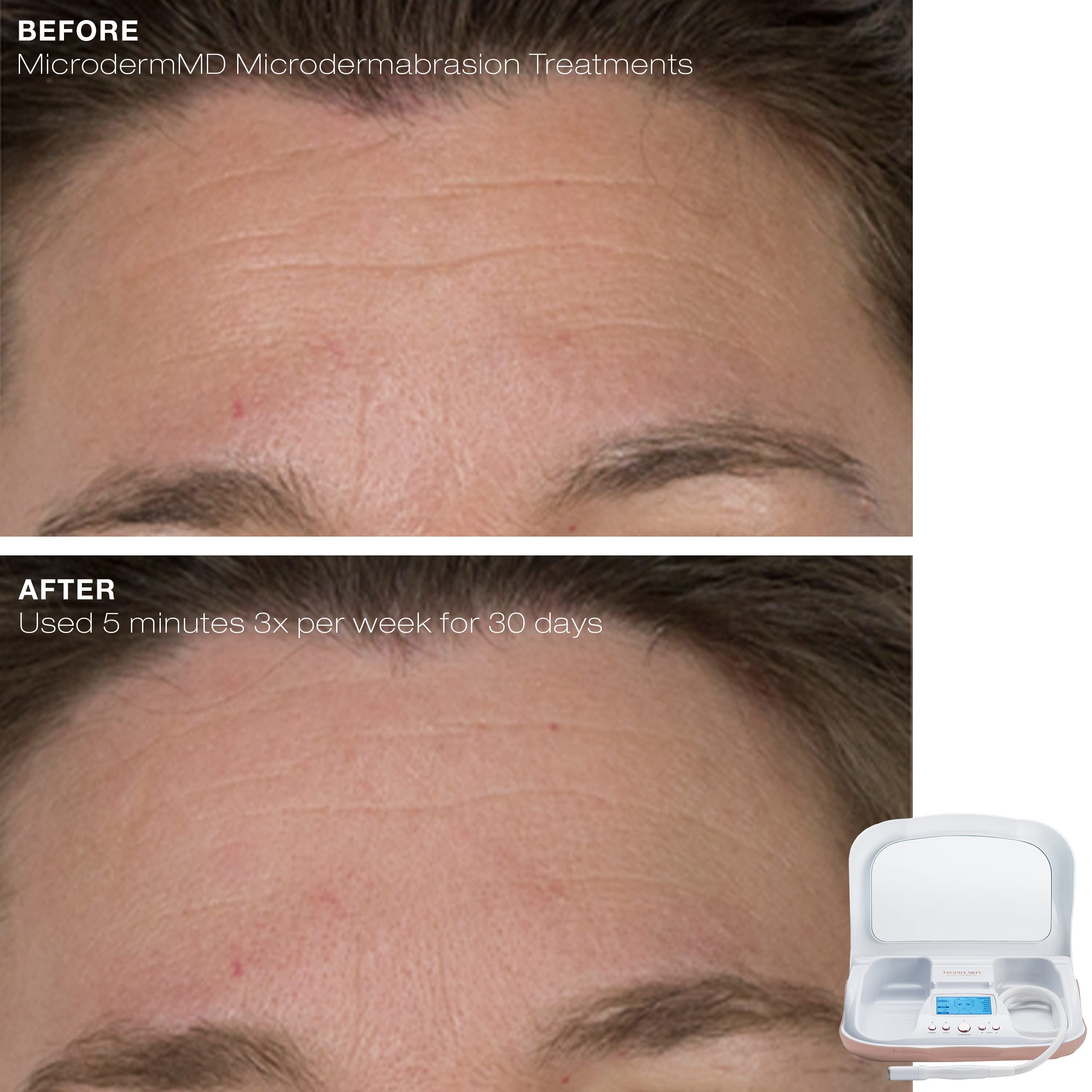 Trophy Skin MicrodermMD Auto Mode close-up for beginner-friendly routines