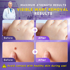 TTsiya Wart Remover Liquid Freeze Off bottle ready for rapid wart treatment