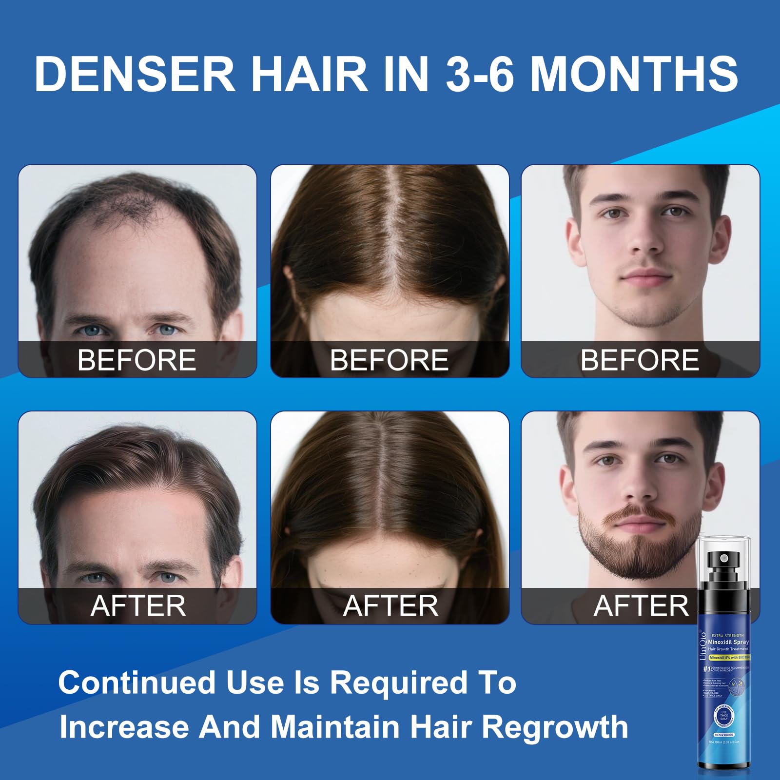 Uinqio Minoxidil spray on scalp with quick absorption for thinning areas.