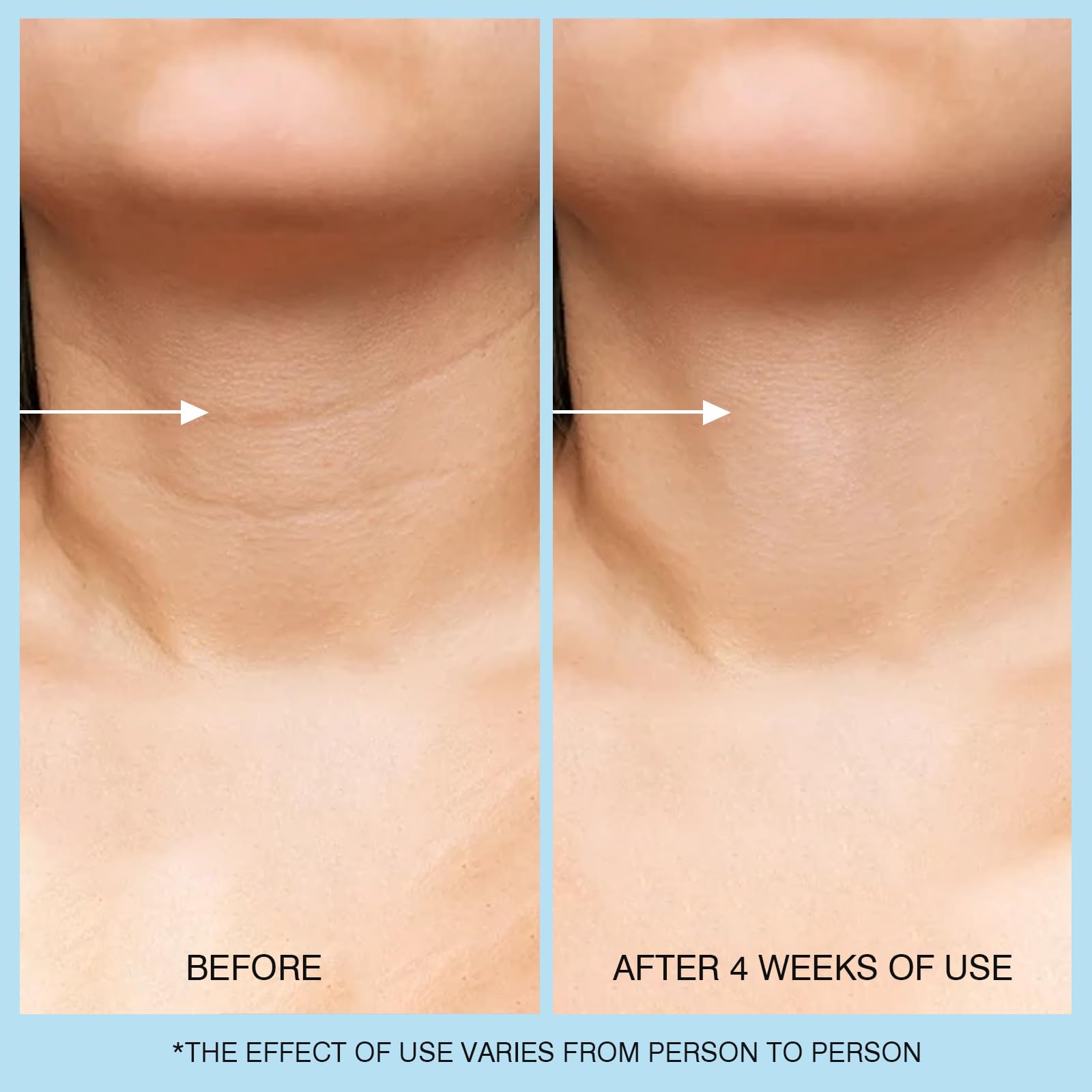 UJHAY Retinol Neck Cream with hyaluronic acid for deep hydration
