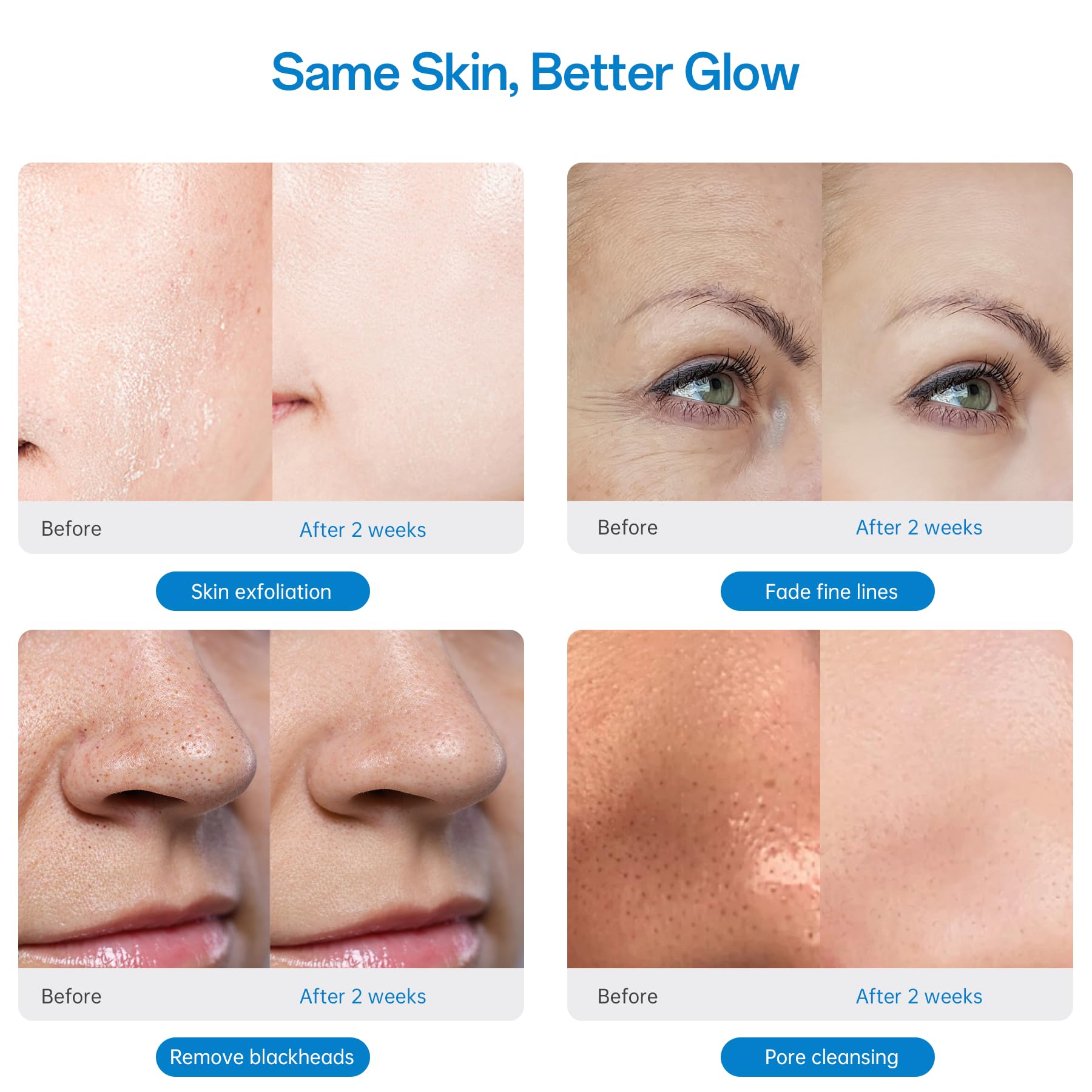 UNOISETION tool near blackheads area demonstration for pore cleansing.