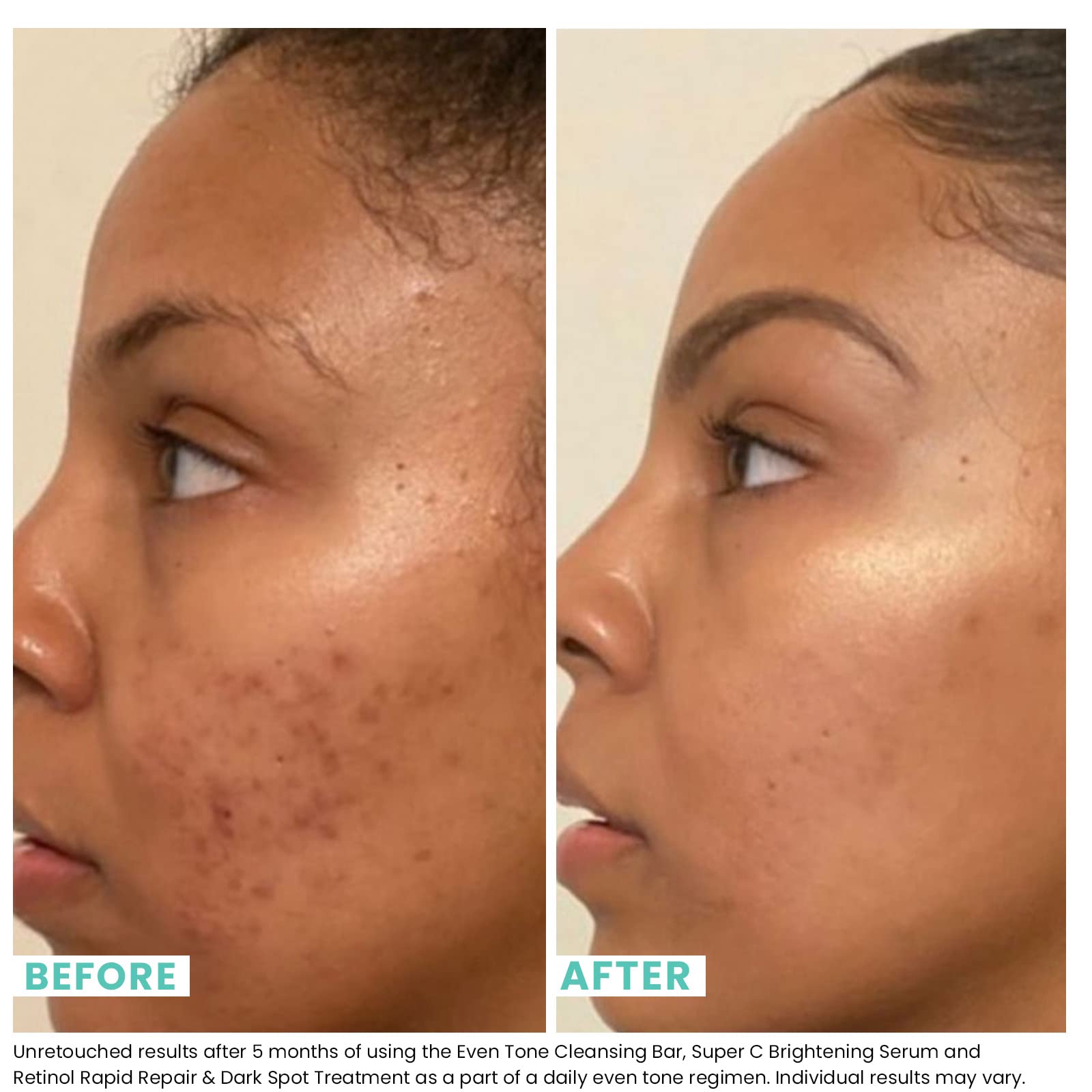 Urban Skin Rx Even Tone Bar lather on face demonstrates creamy cleansing action.