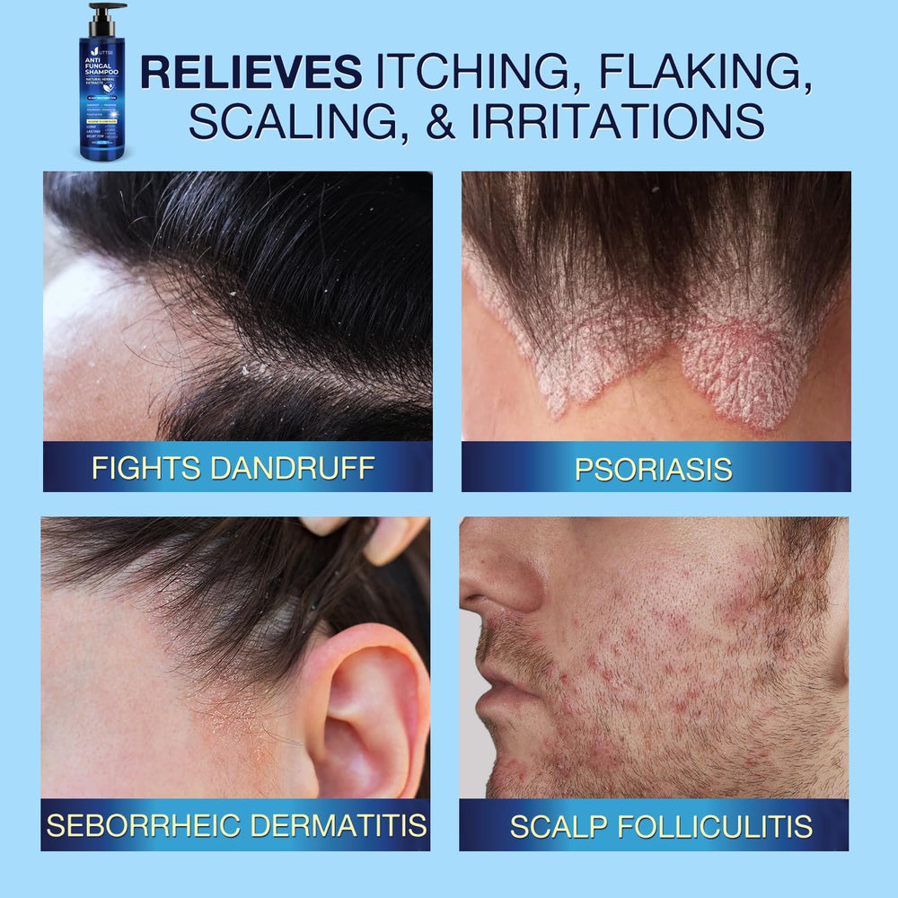 Uttse antifungal shampoo ingredients include salicylic acid and natural botanicals.
