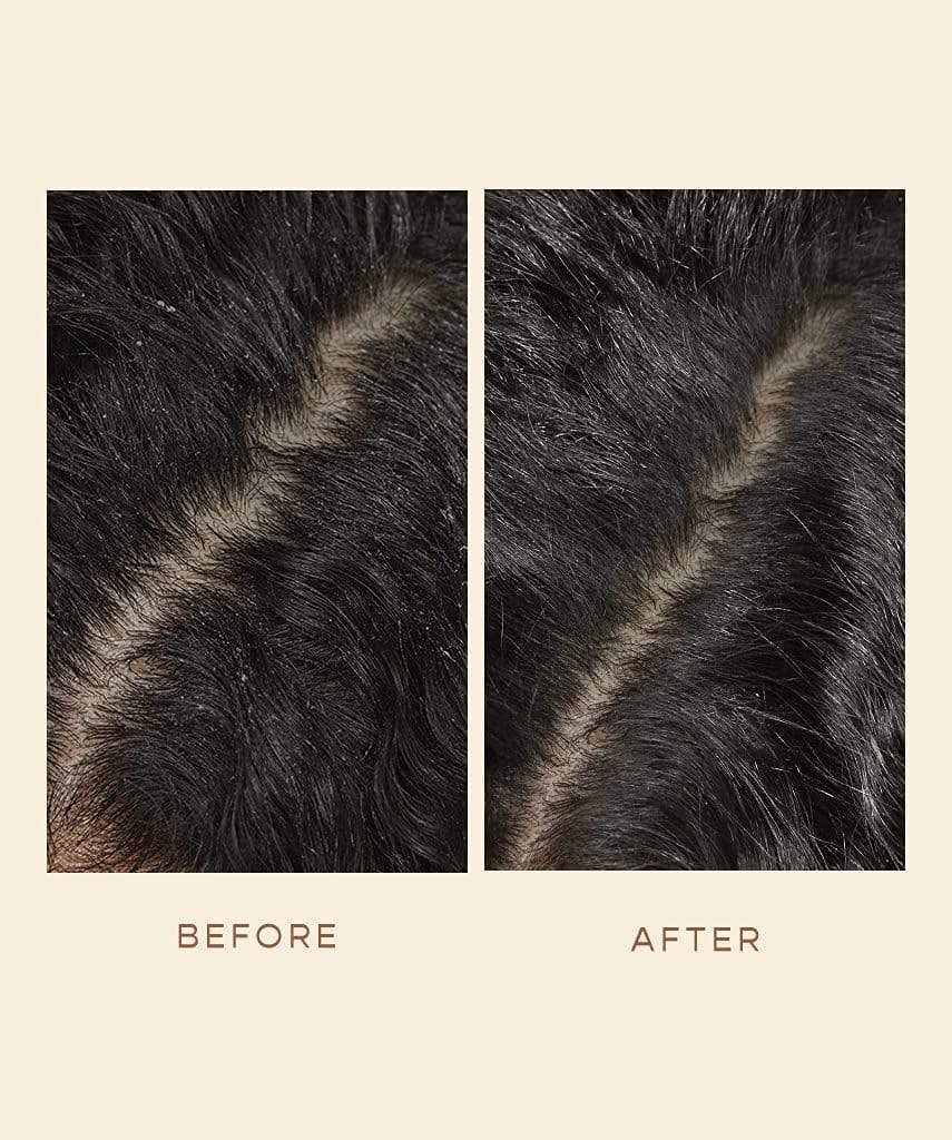 Willowherb component of GRO serum reduces visible flakes on scalp.