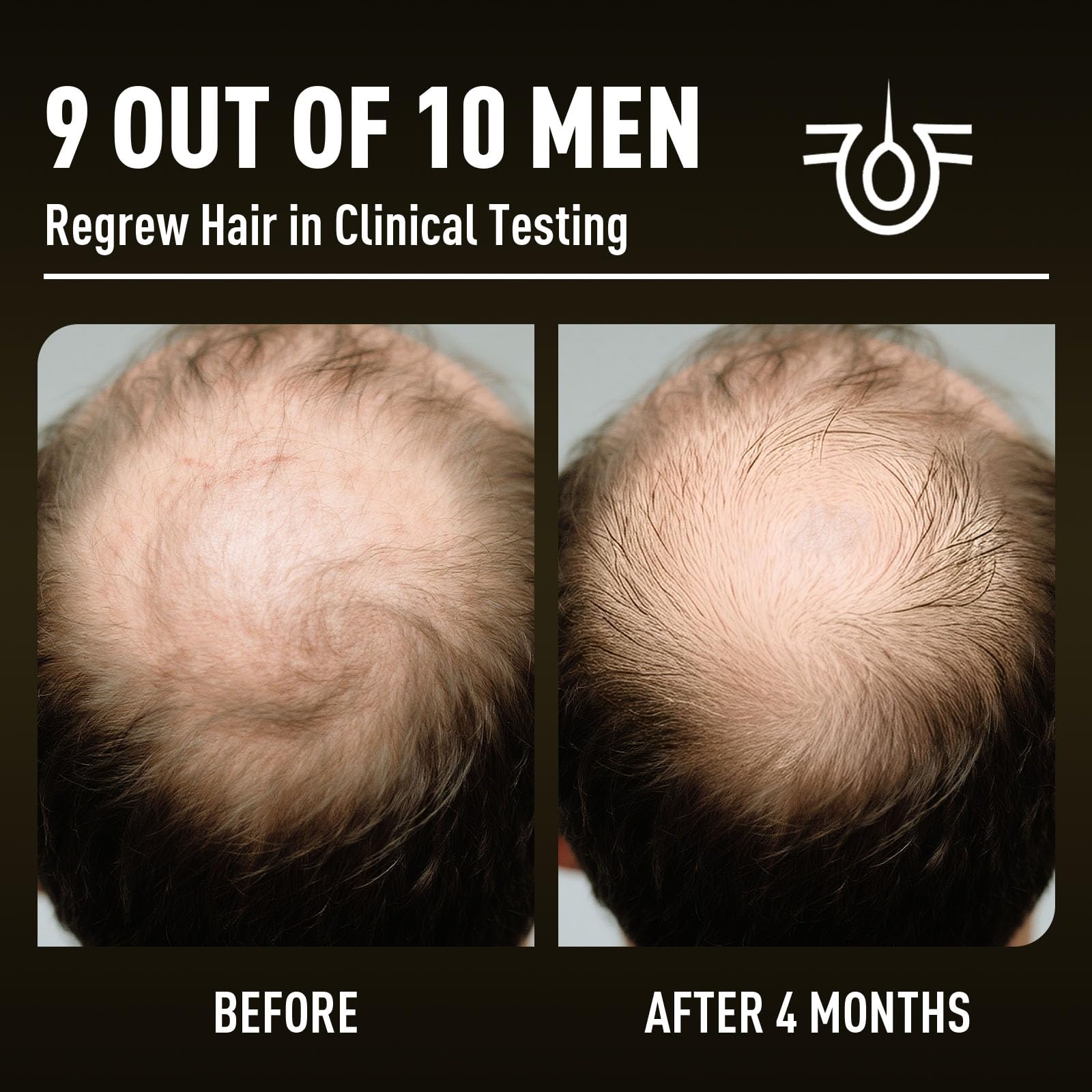 Veiderui Minoxidil Biotin 5% scalp treatment image signaling potential fullness over time