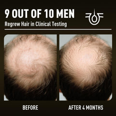 Veiderui Minoxidil Biotin 5% scalp treatment image signaling potential fullness over time