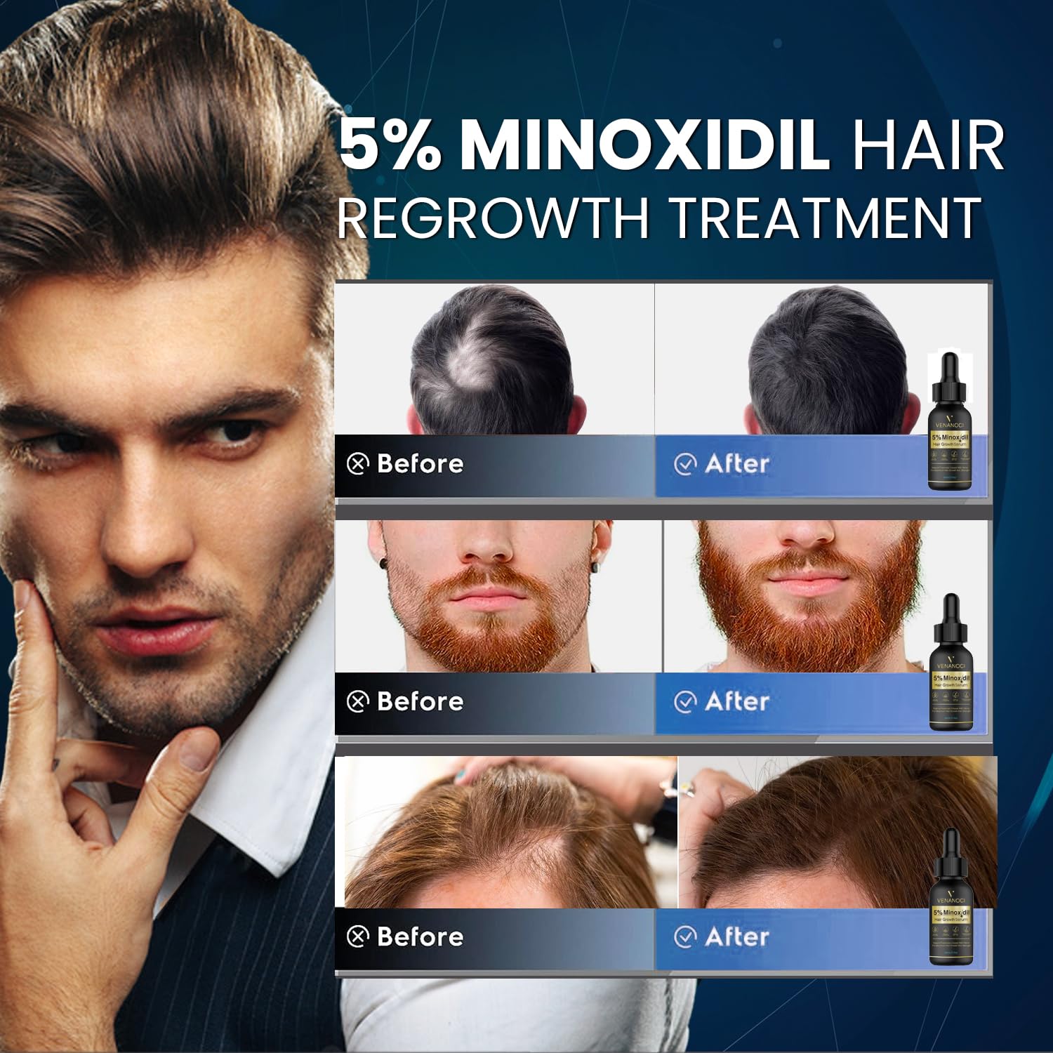 Venanoci minoxidil application dropper ready for scalp use supports regrowth possibilities.
