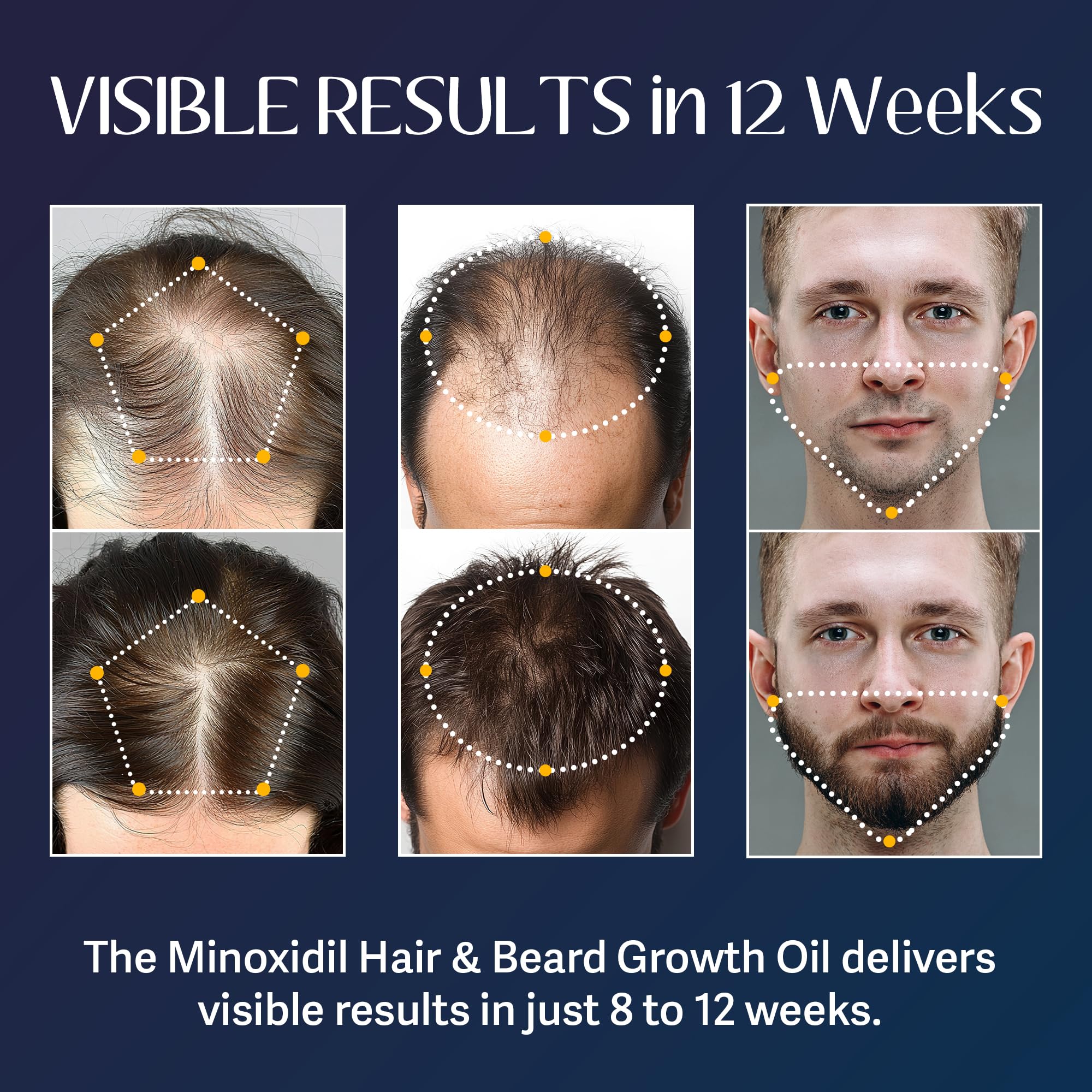 Venanoci minoxidil serum bottle closeup shows potent formula.