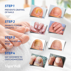 Hydrogel patch on toenail, promoting overnight repair and comfort.