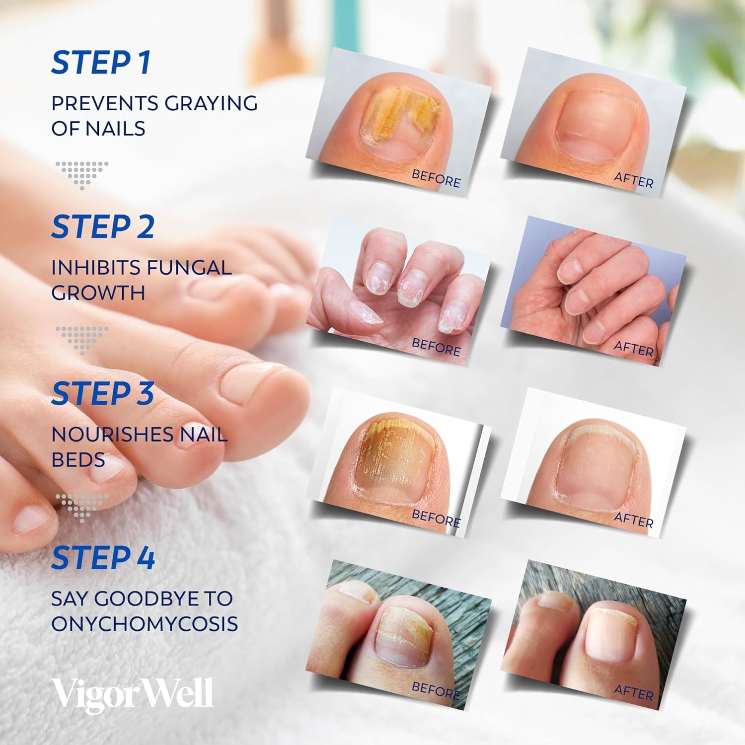 VigorWell toenail fungus treatment kit image with patches and liquid.