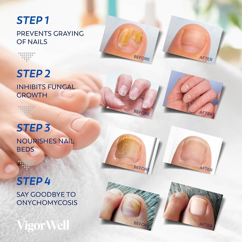 VigorWell toenail fungus treatment kit image with patches and liquid.