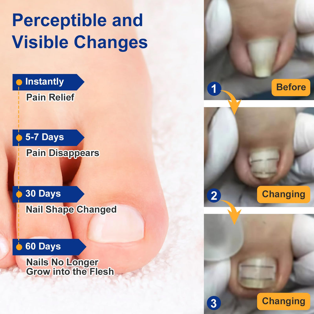 Yanxifei ingrown toenail removal kit in use demonstrates home care