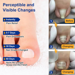Yanxifei ingrown toenail removal kit in use demonstrates home care